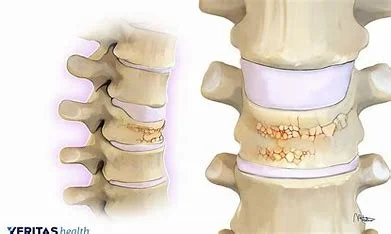 a-percutaneous-is-performed-to-treat-osteoporosis-related-compression-fractures.