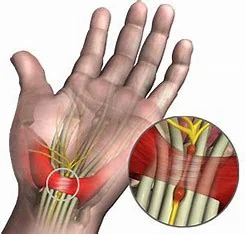 how-to-prove-carpal-tunnel-is-work-related