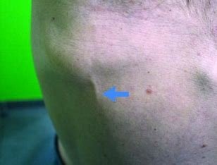 is-mondor's-disease-related-to-cancer